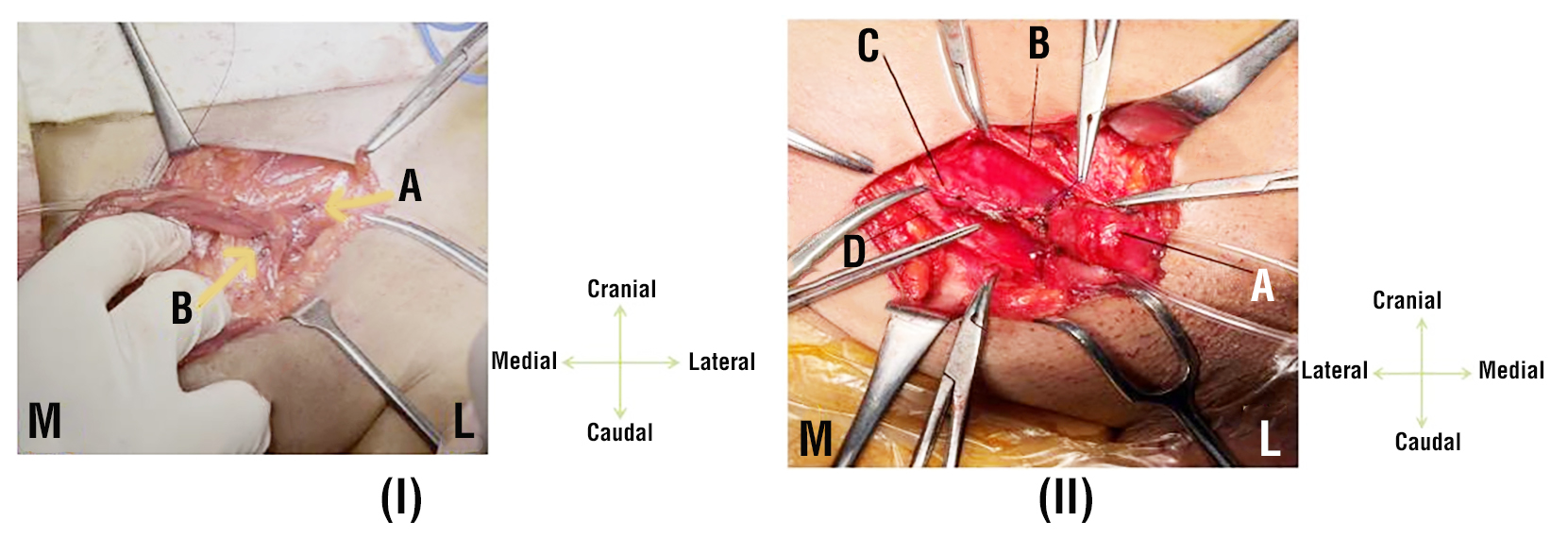 Figure 1 - (I) Guarnieri portion of the repair of left side inguinal hernia. A: Obliterated old internal ring