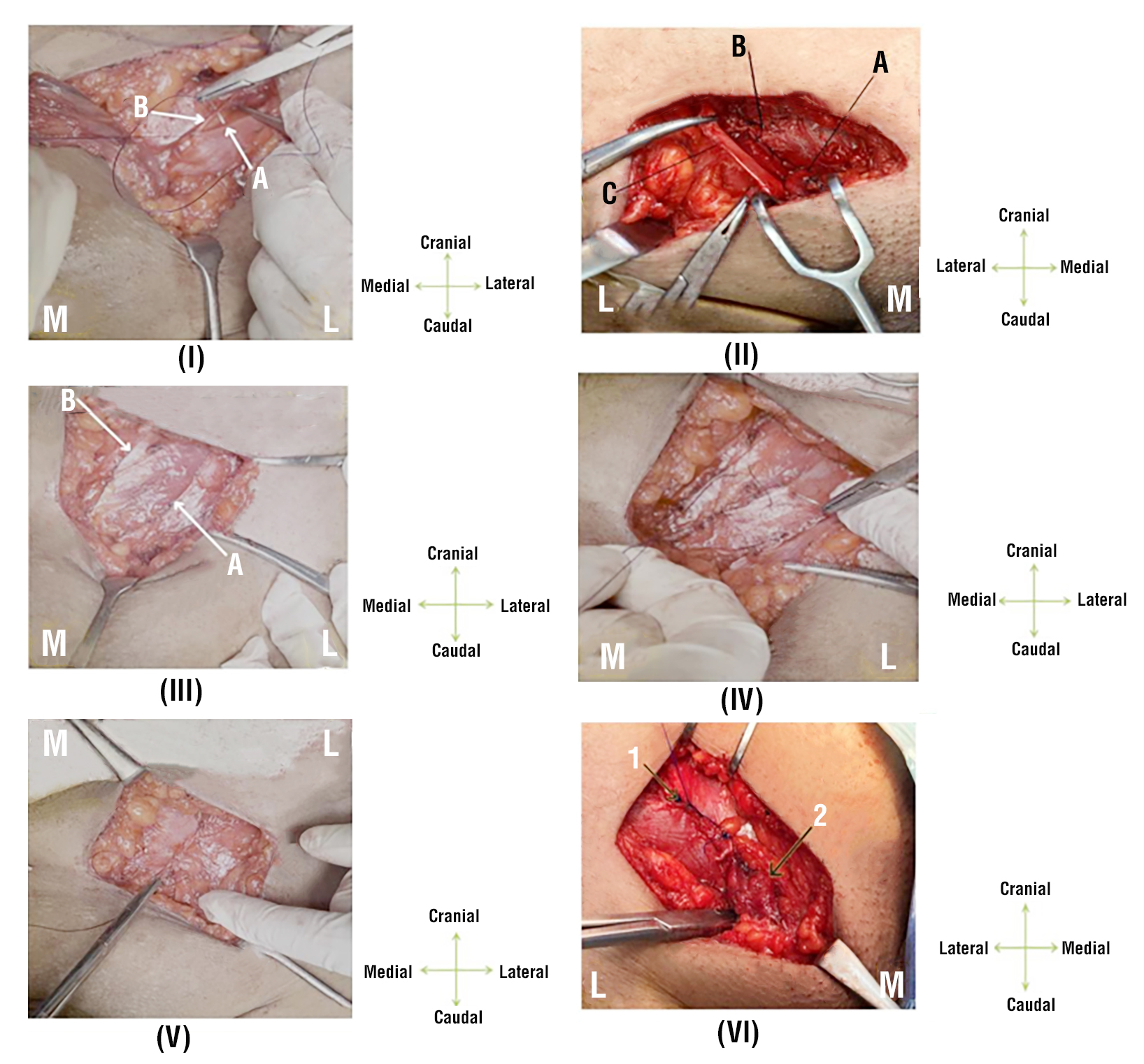 Figure 2 - (I) Desarda Repair of left side inguinal hernia (First Step + EOA sutured to iliopubic tract). A: Iliopubic tract. B: Upper leaflet of EOA. (II) Desarda Repair of right-side inguinal hernia (First Step). A: Medialized spermatic cord. B: EOA sutured to iliopubic tract. C: Lower leaflet of EOA, (III) Utilizing continuous proline 2/0 suture, the top border of the EOA slit was sutured cautiously to the aponeurotic portion of the conjoint tendon avoiding making any tension. Now, we calibrated the newly formed internal ring to admit the little finger's tip and ensure that the contents of the spermatic cord are not </strong><strong>compressed by the new internal ring. (III) " Desarda Repair (Third step), tendinous part of conjoint tendon sutured to lower leaflet of splitting incision" in left side hernia repair. (V) Desarda Repair Last Step" of left side inguinal hernia ( Upper leaflet of splitting incision at EOA sutured to lower leaflet of EOA). (VI) " Last step of Desarda Repair of right inguinal hernia". 1. Upper leaflet of splitting incision at EOA sutured to lower leaflet of EOA. 2. Spermatic cord