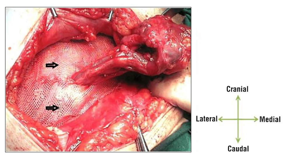 Figure 3 - Lichtenstein tension-free hernioplasty