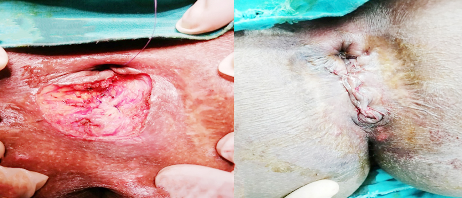 Figure 1 - A case of female patient 36 years old, with delayed repair for post haemorrhoidectomy anal sphincteric injury. (a) intraoperative; (b) postoperative.