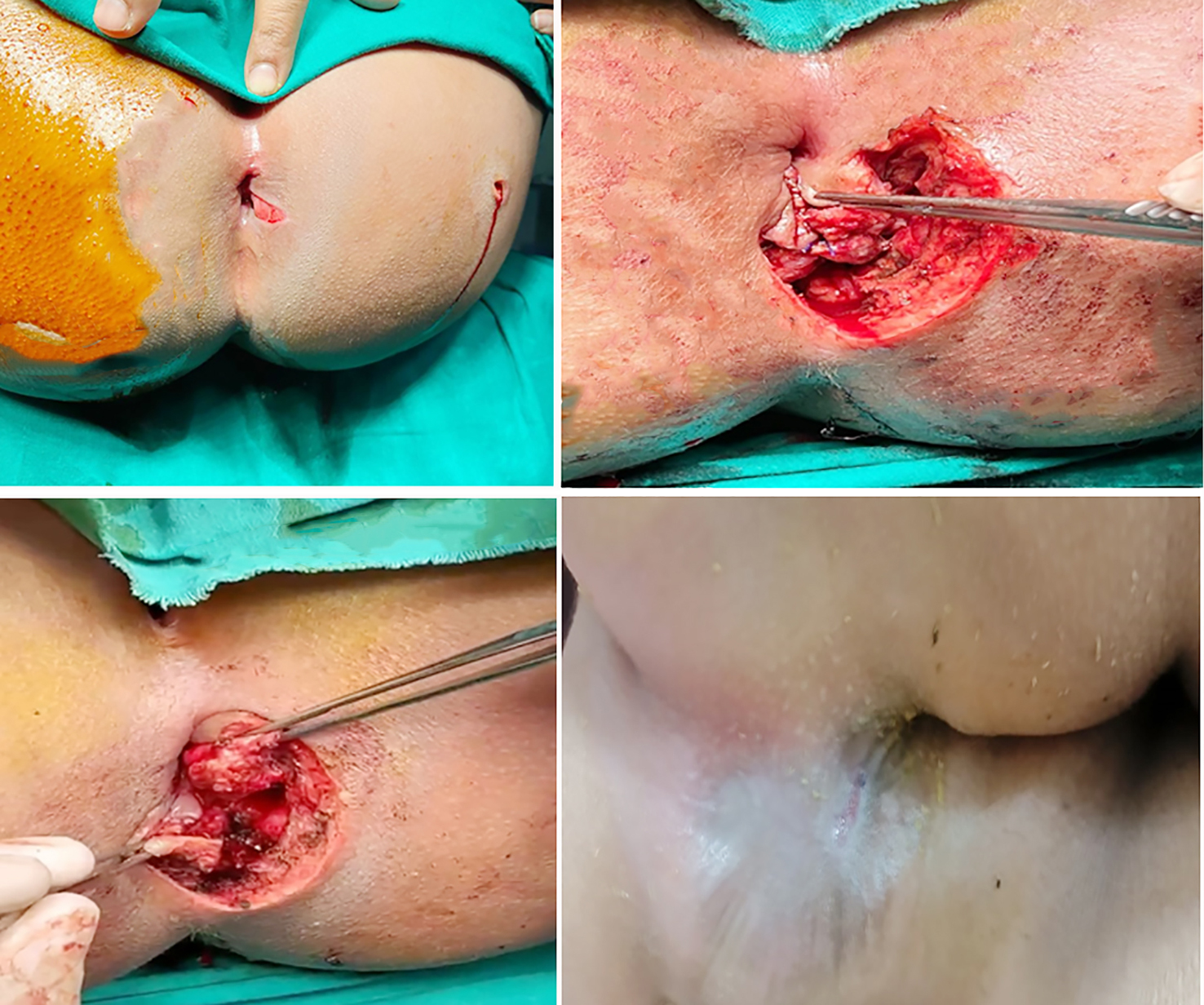 Figure 2 - A case of female child patient 8 years old with immediate repair for post hard object traumatic anal sphincteric injurt. (a) preoperative, (b, c) intraoperative, and (d) postoperative.