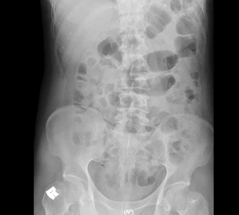 <strong>Figure 1 - Pre-operative abdominal x-ray</strong>