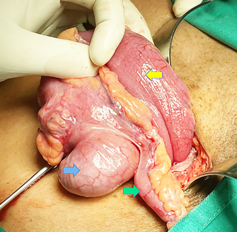 <strong>Figure 2 - Contents of the inguinal hernia sac, which includes the caecum (blue arrow), appendix (green arrow), and terminal ileum (yellow arrow)</strong>