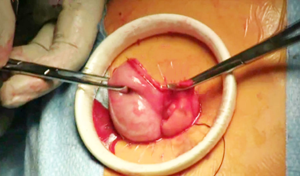 <strong>Figure 1 - Use of wound edge protector during open appendectomy showing ring placement at incision edge</strong>