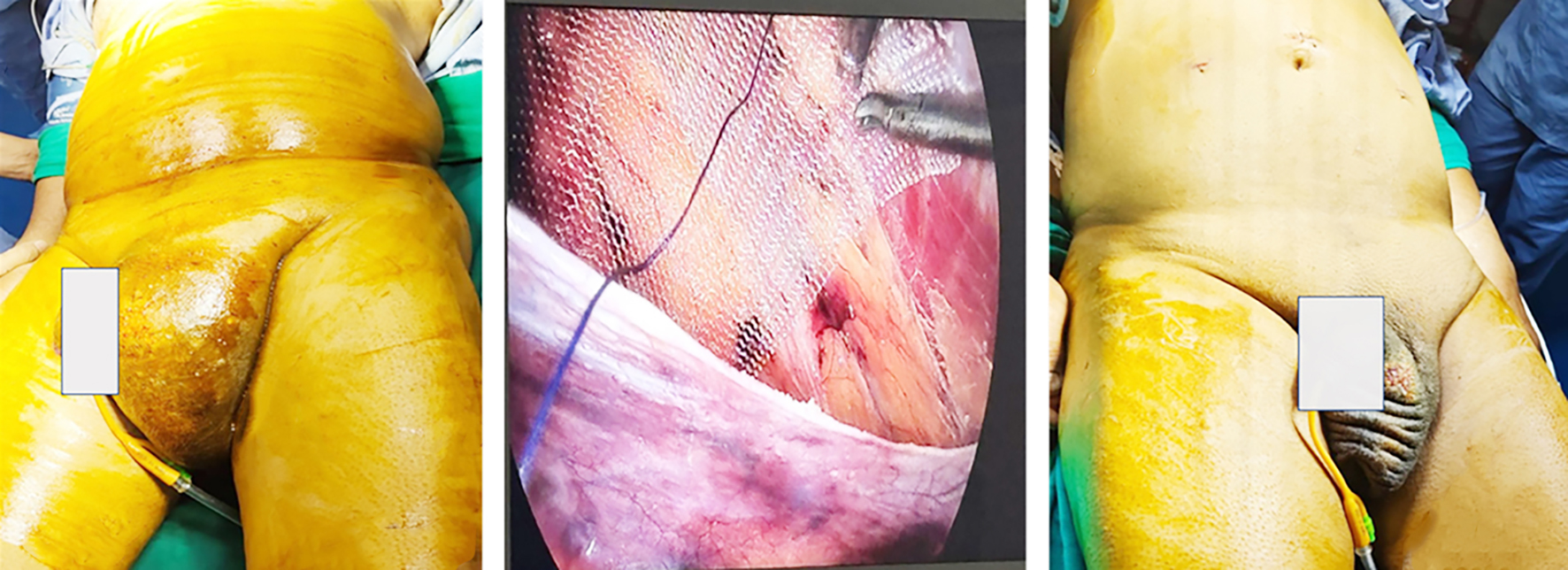 Figure 3 (a-c) - Representative case from the study showing laparoscopic left inguinal hernia repair using Merigrow™ Mesh. (a) Preoperative left inguinal swelling, while (b) shows Intraoperative mesh placement and (c) depicts the postoperative resolution with healed port sites.