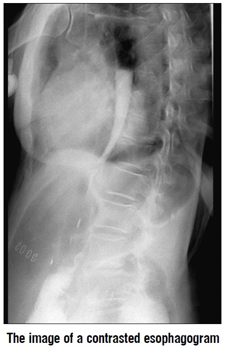 contrasted esophagogram