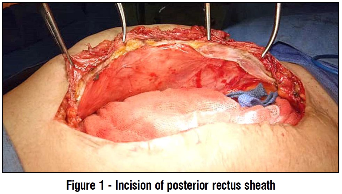 Incision of posterior steath