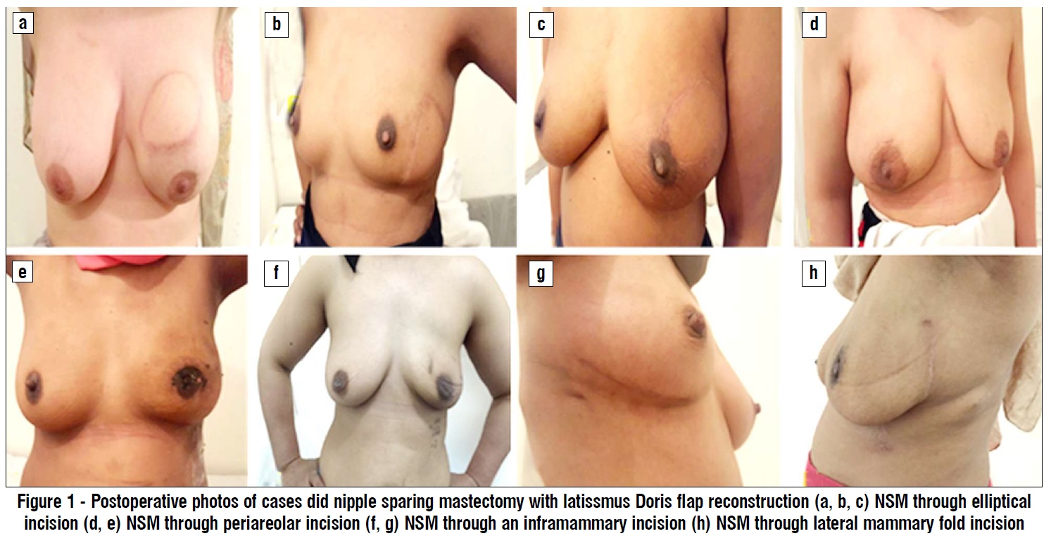 postoperative nipple sparing masectomy