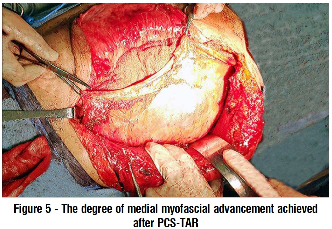 degree of medial myofascial advancement after PCS-TAR