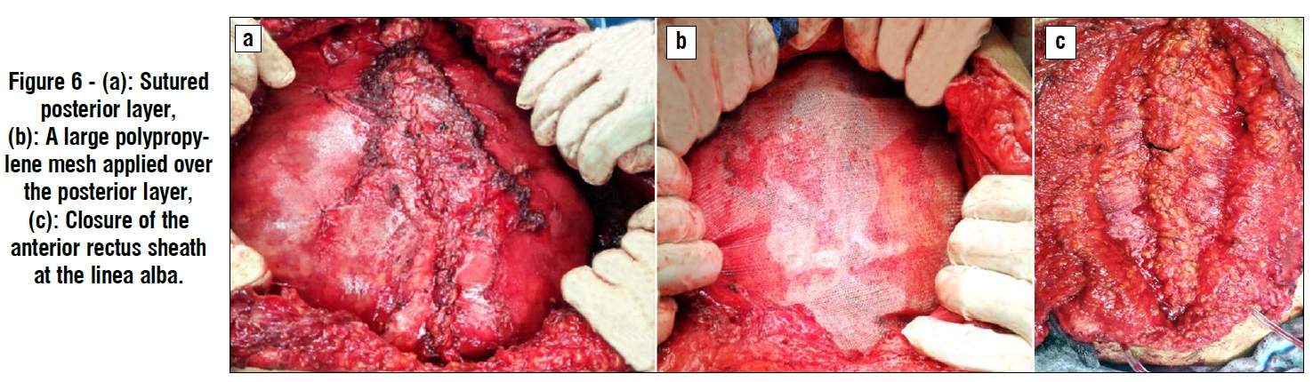 sutured posterior layer
