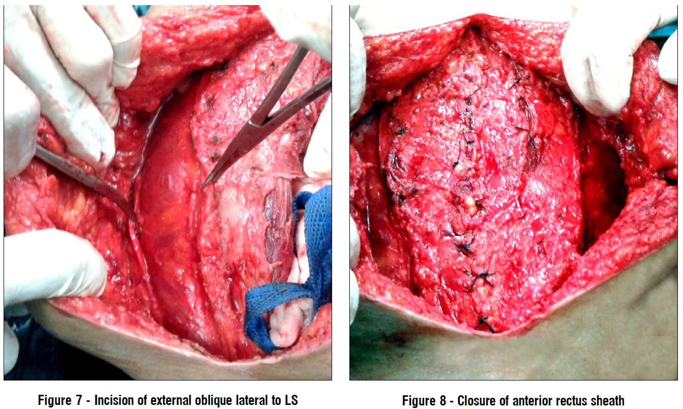 incision of external; oblique lateral LS