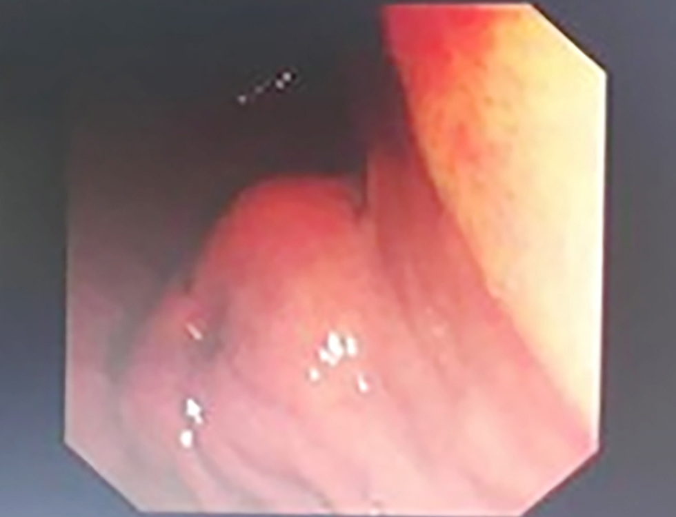 <strong>Figure 2 - Endoscopic view of the gastric antrum: Endoscopic image showing the gastric mucosa with potential submucosal lesion suspicious for GIST. (SCV: Scope Channel View; C:N Br:A1 G:O refers to endoscopic coordinates and settings with C:N indicating Color/Normal mode, Br:A1 indicating Brightness level A1, and G:O indicating Gain/Offset settings)</strong>