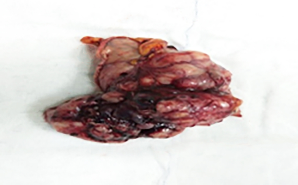 <strong>Figure 3 - Surgical specimen after gastric wedge resection: Macroscopic view of the resected gastric GIST specimen showing a well-circumscribed, submucosal solid mass with areas of hemorrhage.</strong>